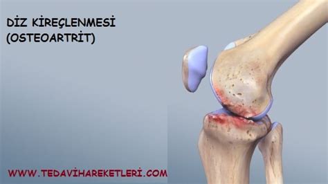 osteokondroz nasıl tedavi edilir, lomber osteoartrit evre 1-2
